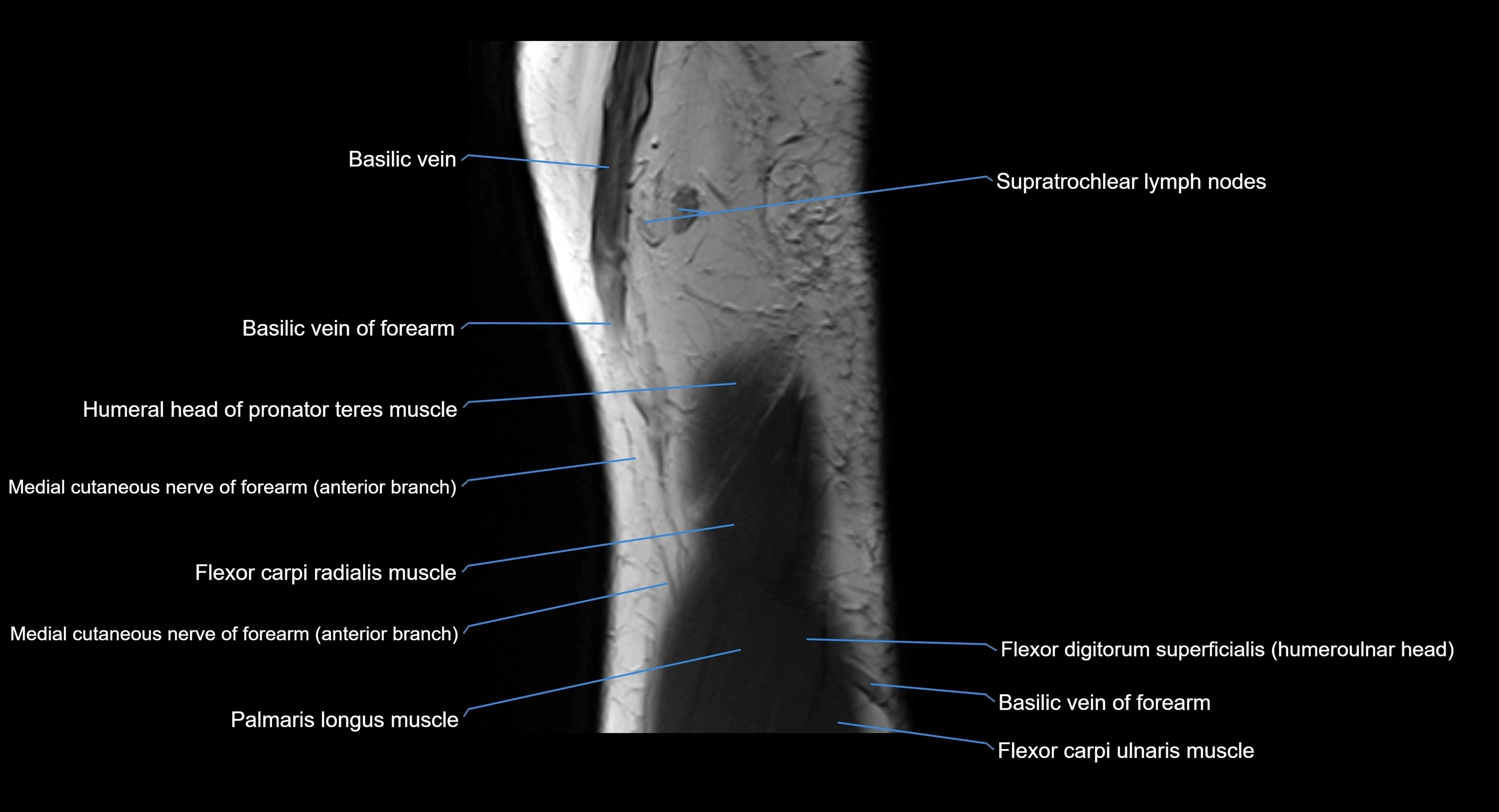 MRI elbow joint  sagittal cross sectional anatomy 3T  radiology  image-img-00001-00005.webp